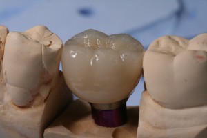 implant