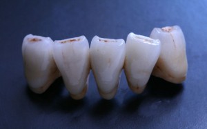 metalbond